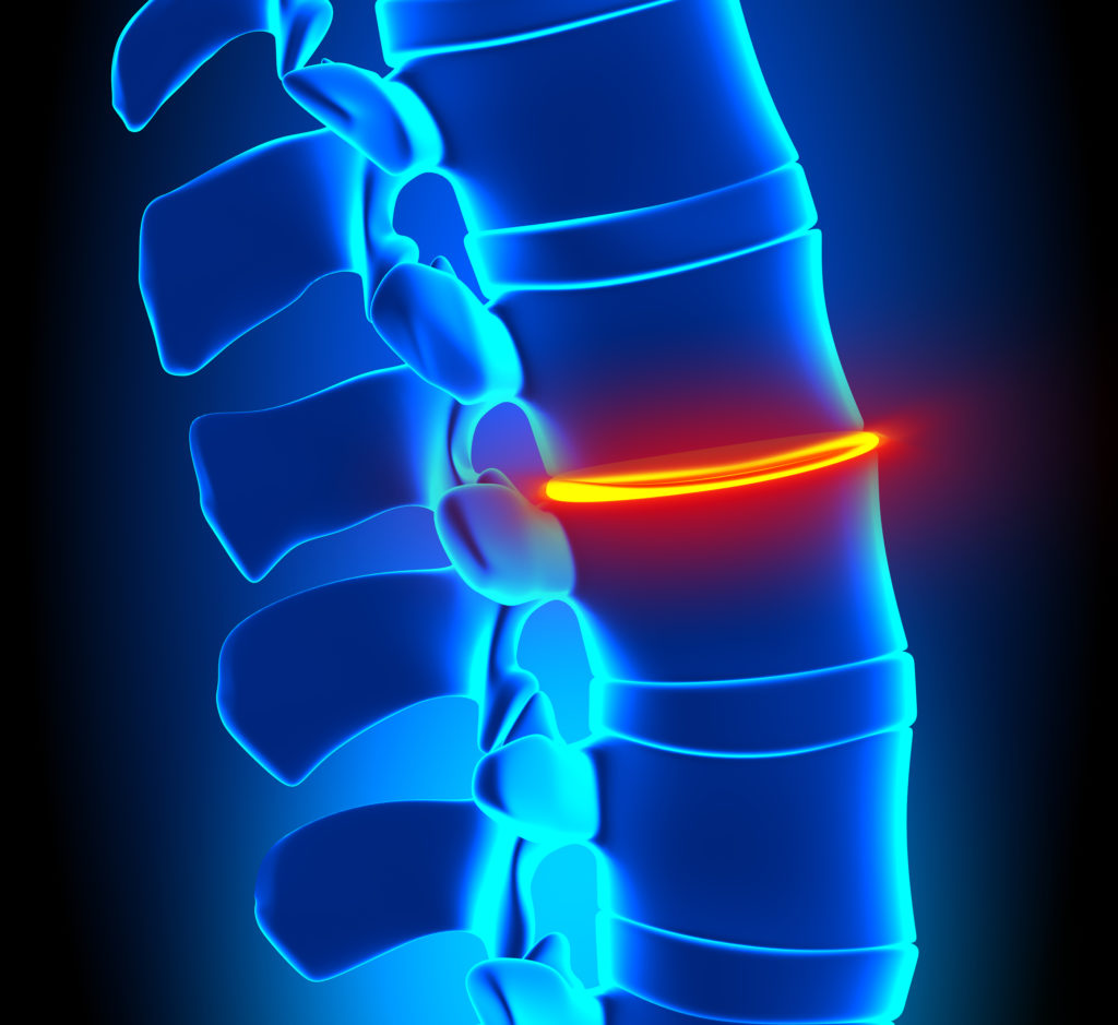 Degenerative Disc Disease