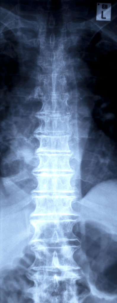 Osteoarthritis and the Spine